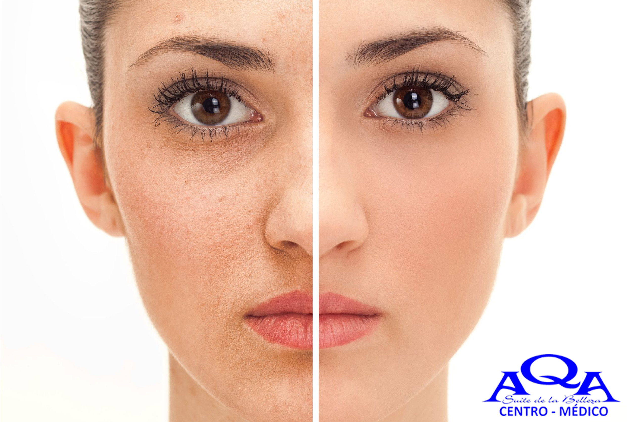 Tratamiento que trata las imperfecciones de la piel y los poros dilatados. Combinamos tratamientos a base de peeling químicos y fototerapia lumínica.